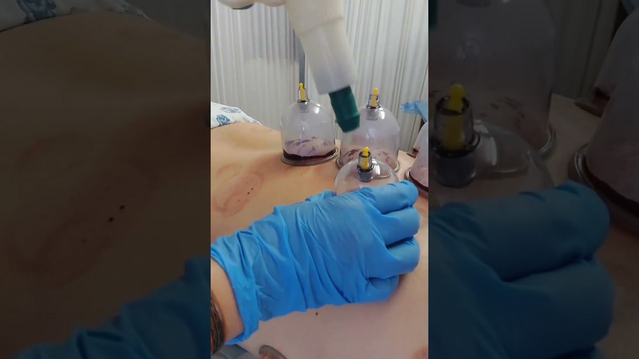 ХИДЖАМА. #хиджама #капилляротерапия смотреть онлайн