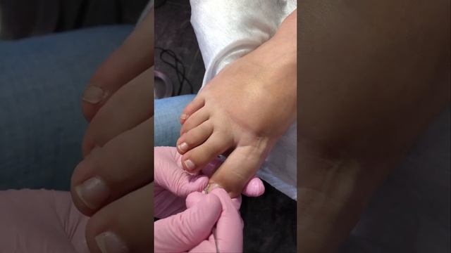 Тампонирование вросшего ногтя. смотреть онлайн