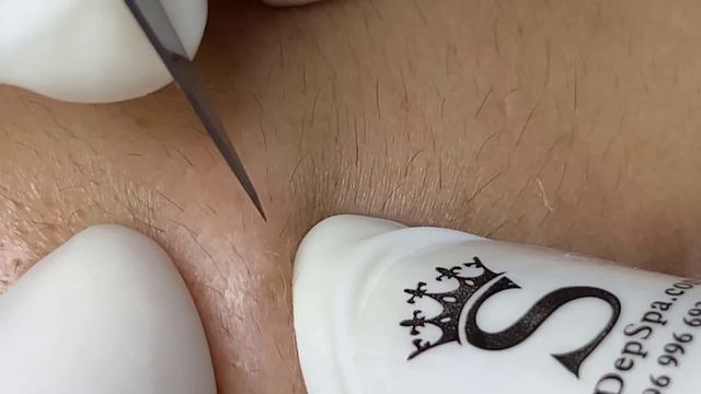 Extremely Terrible Blackhead Treatment At Sac Dep Spa смотреть онлайн