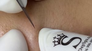 Extremely Terrible Blackhead Treatment At Sac Dep Spa