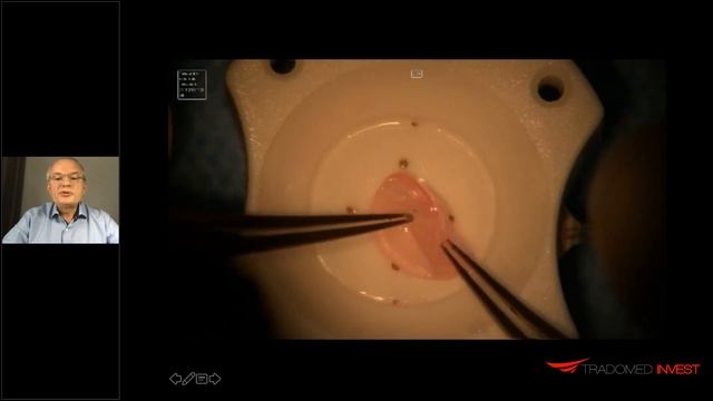 Селективный подход – современный этап развития кератопластики смотреть онлайн
