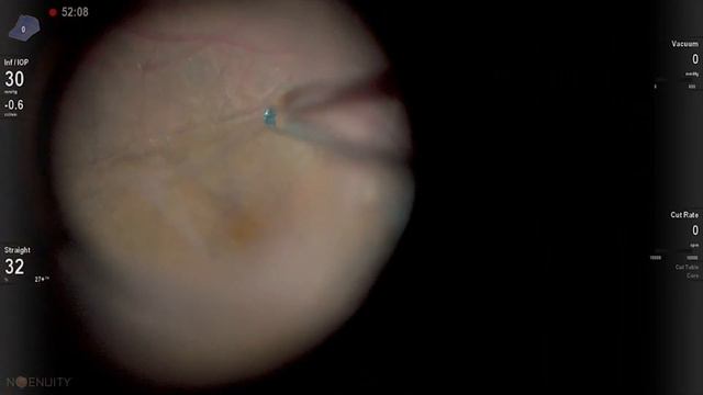 27Gauge PPV using 10k Ultravit (Alcon): Epiretinal membrane removal смотреть онлайн