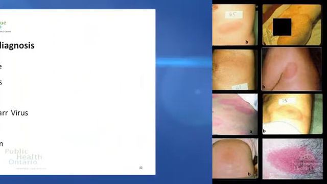 Chapter 5: Clinical Presentation - Challenges in Lyme Disease Diagnosis and Treatment смотреть онлайн