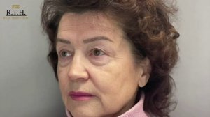 ДО и ПОСЛЕ блефаропластики: результат спустя 6 дней.