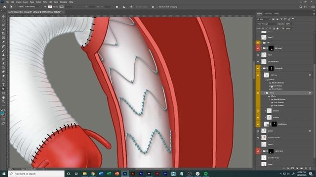 Medical illustration Photoshop tutorial: Using layer styles to draw metal wire stents смотреть онлайн
