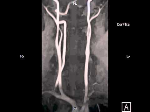 Бесконтрастная МР ангиграфия артерий шеи смотреть онлайн