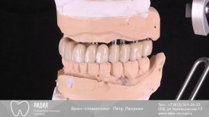 Коронки на имплантатах. Верхняя челюсть
