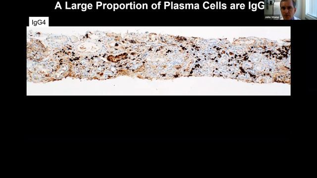 IgG4 Related Diseases смотреть онлайн