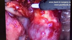 Дермоидная киста яичника - прямое показание к оперативному лечению