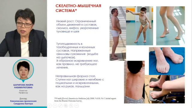 Клинические проявления синдрома Хантера МПС 2 Шарипова М Н смотреть онлайн