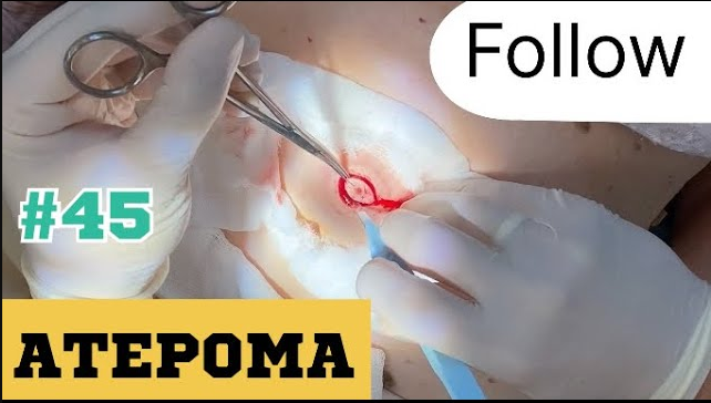 45. Удаление атеромы живота