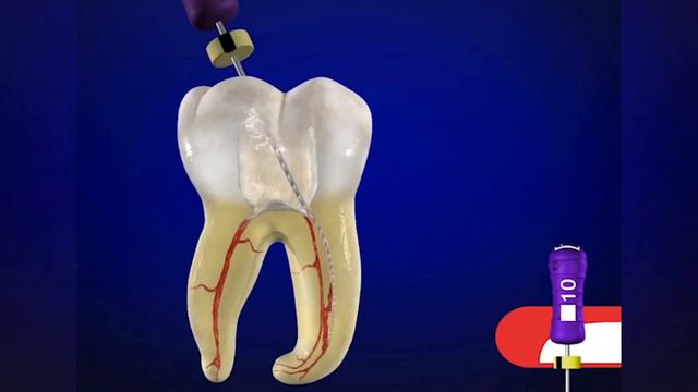 ProTaper Gold® SX File With Dr. Cliff Ruddle  | Dentsply Sirona