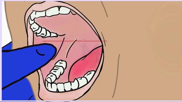 Inferior alveolar nerve block technique смотреть онлайн