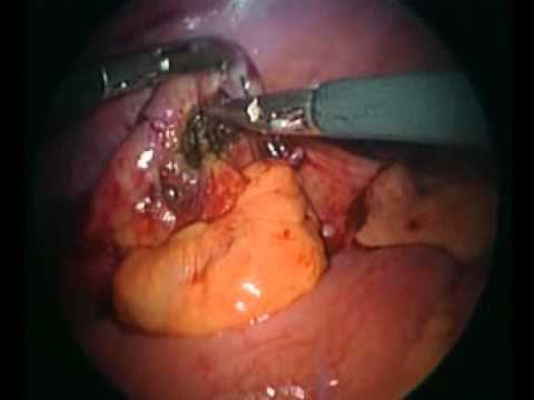 аппендицит лапароскопическое удаление
