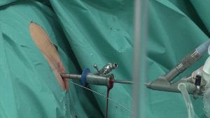 Эндоскопический метод: как через небольшой надрез удаляют камни в почках