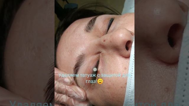 Лазерное удаление татуажа век с защитой для глаз Оренург смотреть онлайн