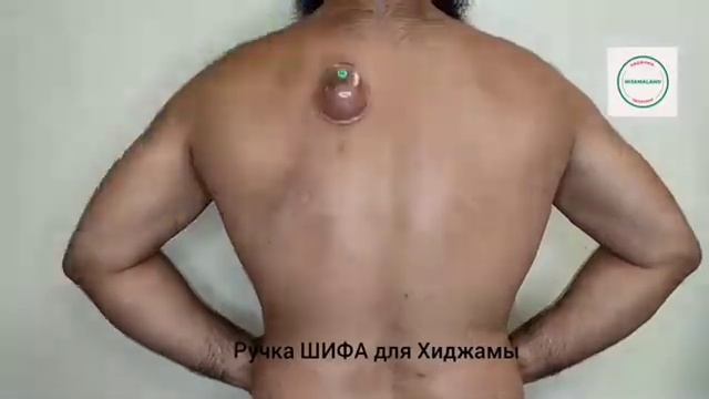 Рекомендуемые точки Хиджамы при избыточном весе! смотреть онлайн