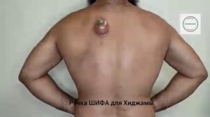 Рекомендуемые точки Хиджамы при избыточном весе!
