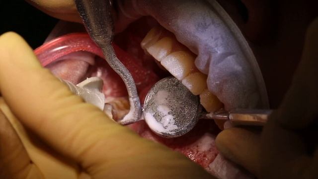 Профессиональная гигиена полости рта. Комплексная чистка зубов. смотреть онлайн
