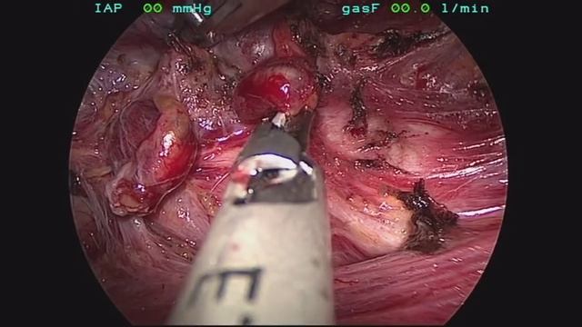 Endoscopic total thyroidectomy with node dissection for papillary thyroid cancer смотреть онлайн