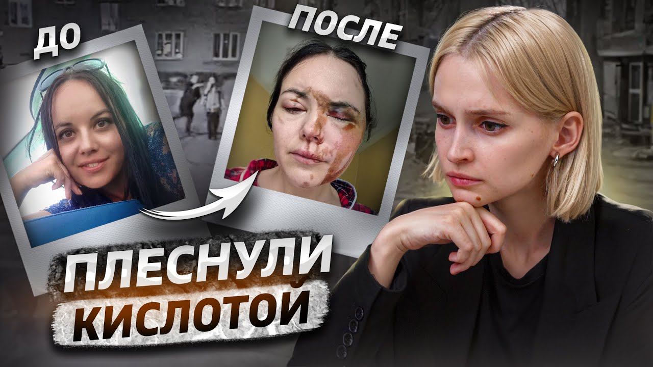 «Меня облили кислотой» | Кислотный маньяк из Монино смотреть онлайн