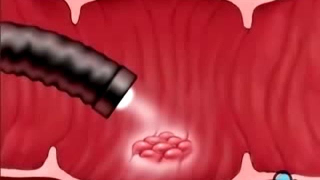 Колоноскопия без боли (во сне) - Москва ЦКБ Гражданской авиации смотреть онлайн