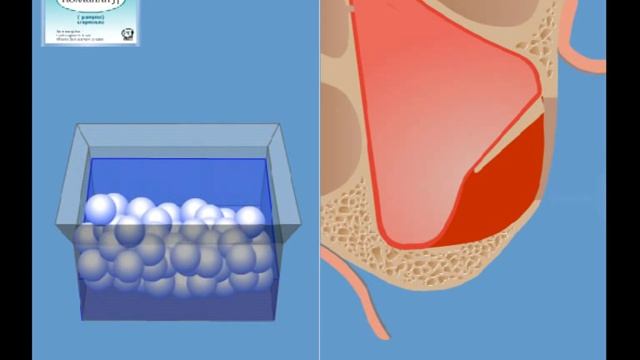 Синуслифтинг