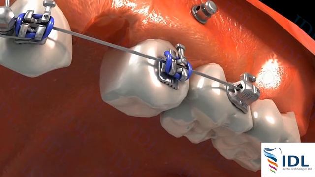 Orthodontic screw IDL (Ортодонтический винт IDL) смотреть онлайн