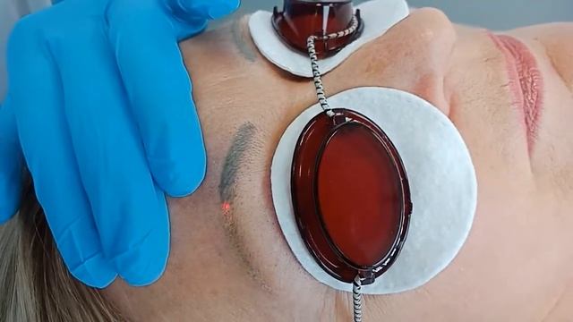 Удаление татуажа смотреть онлайн