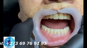 Полносъёмный протез на имплантах - пациенту 74 года