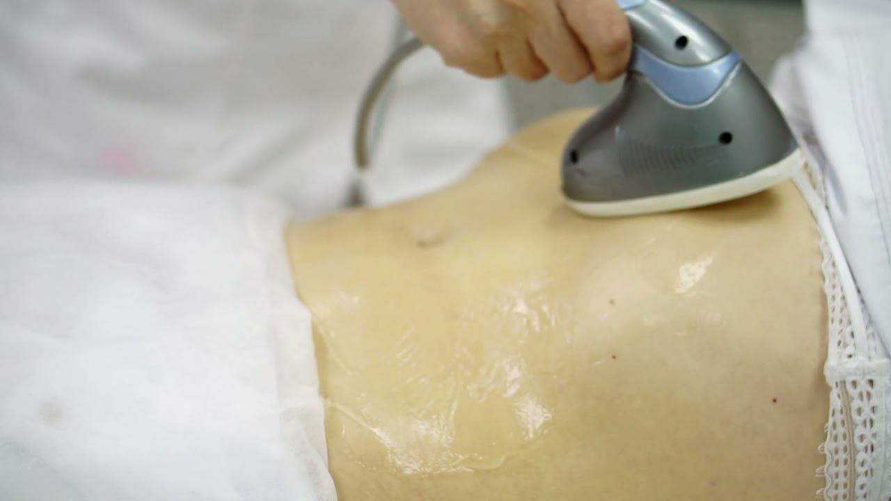 RF-лифтинг тела. смотреть онлайн