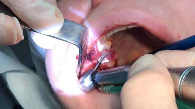 Синус-лифтинг, удаление зубов с одномоментной дентальной имплантацией. Профессор Орлов А.А.