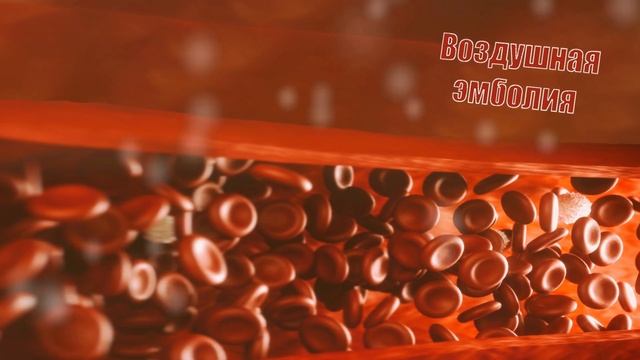 Эмболия смотреть онлайн