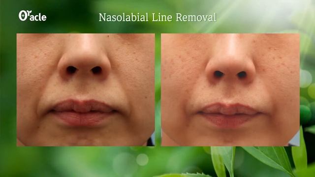 Marionette Filler (Nasolabial Line Removal) at Cheongdam Oracle Clinic - South Korea смотреть онлайн