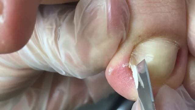 Very long toenails, clean the dirt under the ingrown nail【Crazy pedicure room】 смотреть онлайн