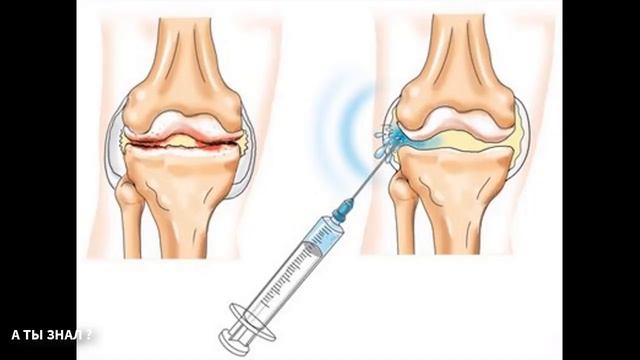 СУСТАВЫ БУДУТ РАБОТАТЬ КАК НОВЫЕ ЕСЛИ .../ АРТРОЗ причины , как сохранить суставы здоровыми ? смотреть онлайн