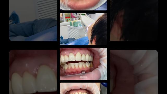 Отбеливание Zoom4. Отбеливание зубов в Москве. Врач - стоматолог Зорин Роман Игоревич.