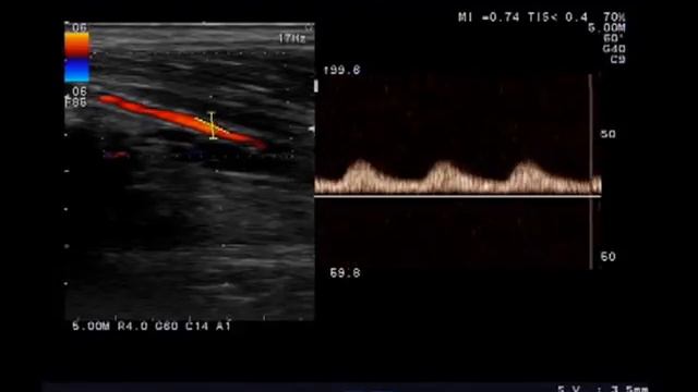 Окклюзия ПБА - дистальные изменения: коллатеральный кровоток в ПББА