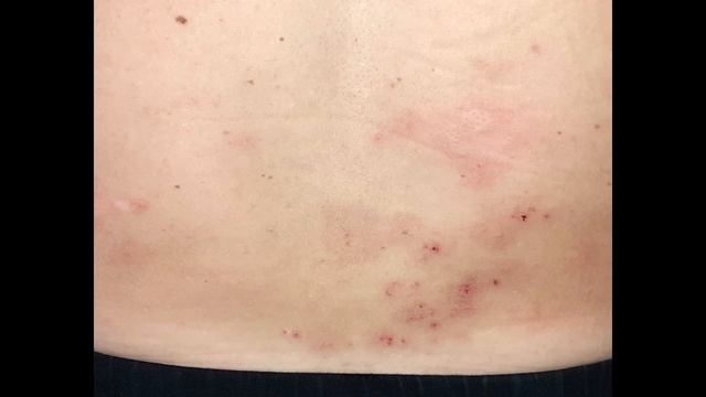 Средство при укусах клопов смотреть онлайн