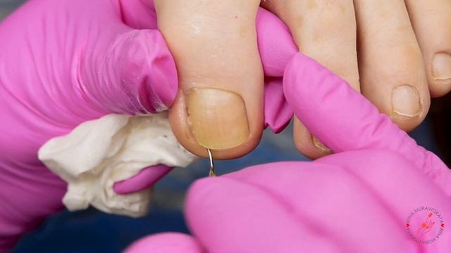 Онихолизис, Пустота под ногтем на ногах | Покрытие пораженного ногтя | Часть 1 смотреть онлайн