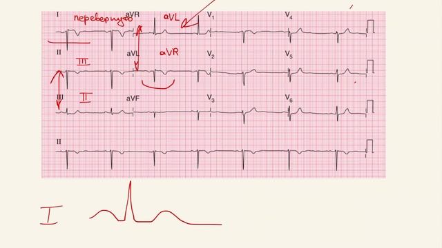 Анализ ЭКГ. Как понять по ЭКГ, что неправильно наложены электроды??