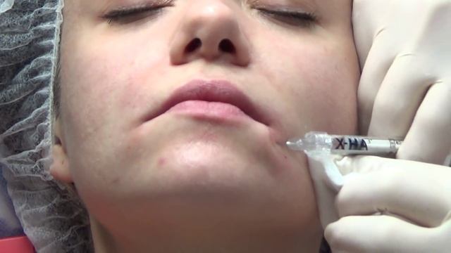 «Улыбка Мона Лизы» — подъем опущенных уголков рта за 1 процедуру смотреть онлайн