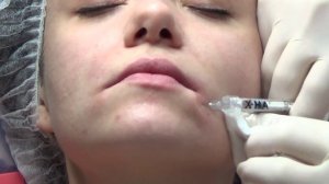 «Улыбка Мона Лизы» — подъем опущенных уголков рта за 1 процедуру