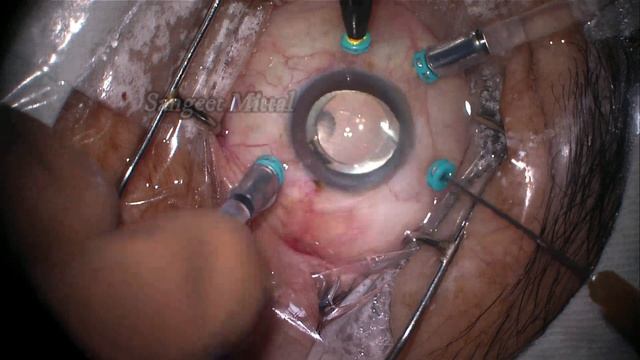 Direct PFCL SO exchange смотреть онлайн