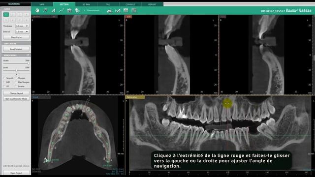 Vatech Ez3D i TUTORIEL SECTION Tab 02 Vue de la section manipulation des courbes - SYNERGY DENTAL смотреть онлайн