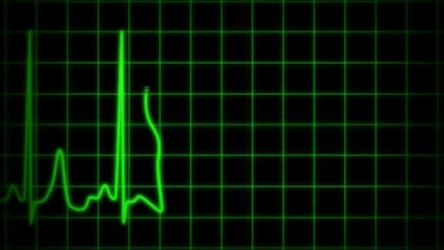 eletrocardiograma смотреть онлайн