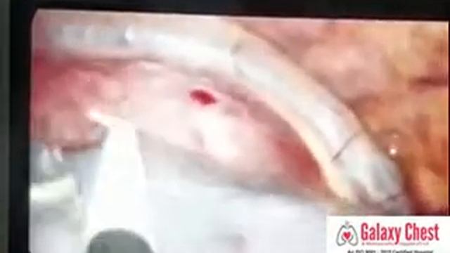 thoracoscopic Mediastinal Lymph Node Biopsy смотреть онлайн