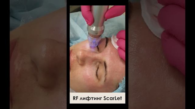 Фракционный микроигольчатый RF-лифтинг на аппарате Scarlet смотреть онлайн