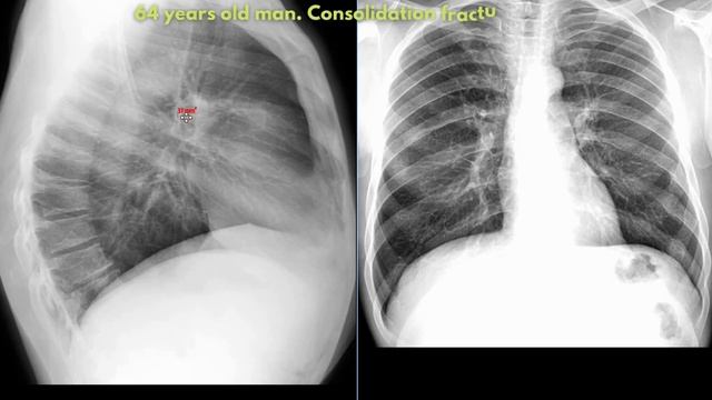 Fractures and consolidation | Things Found In An Xray | Radiological Survey Images смотреть онлайн