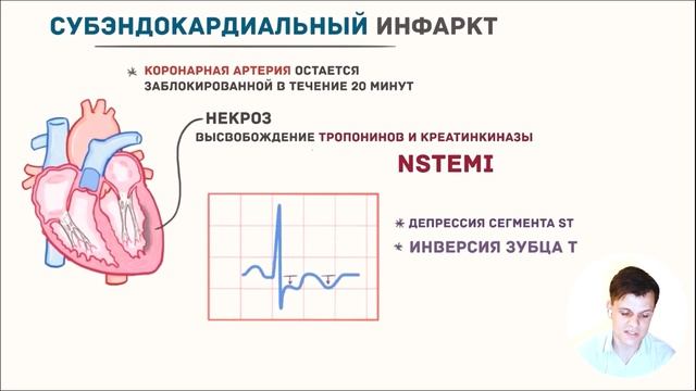 ЭКГ за 100 минут №7: Ишемия и Инфаркт на ЭКГ